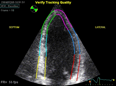 Heart ultrasound